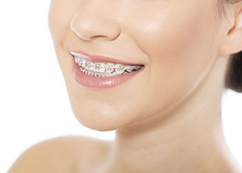 How Do Braces Move Teeth in The Right Position