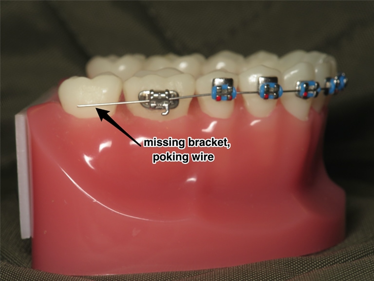What Are the Hooks on Braces For?