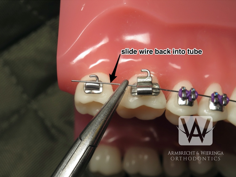 Pokey Braces Wire Causing You Pain? Here's How to Fix It in a Pinch –  Crescent Orthodontics
