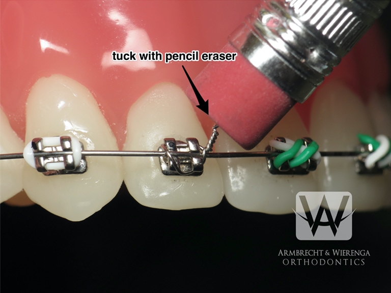 Orthodontics Australia  What to Do When Your Braces Wire Breaks?