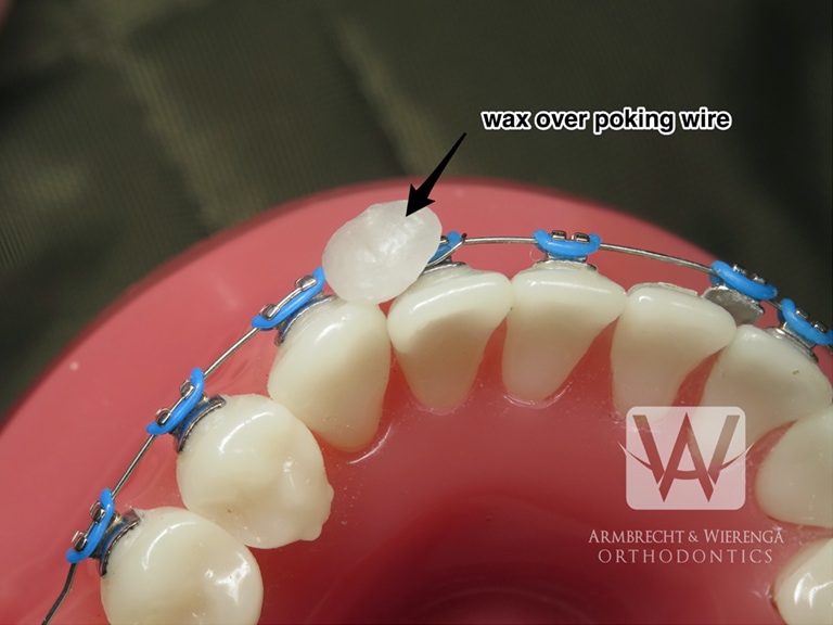 My Wire Came Loose and is Poking, What Do I Do? - Ask an Orthodontist.com