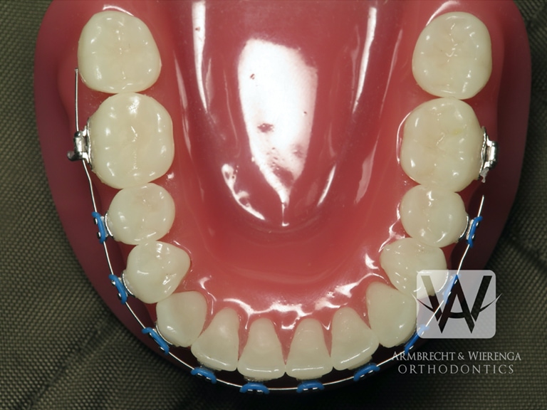 What Should You Do If A Bracket Or Wire Breaks On Your Braces? - Weston  Dental Office
