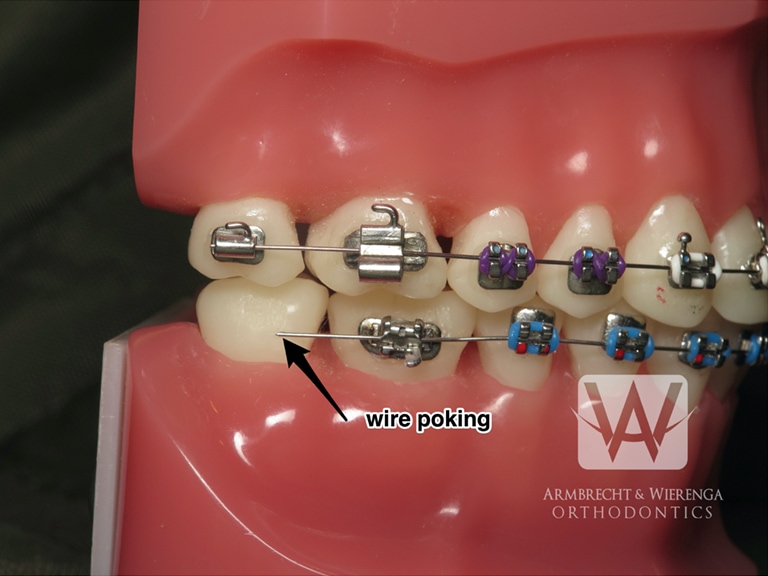 Pokey Braces Wire Causing You Pain? Here's How to Fix It in a Pinch –  Crescent Orthodontics